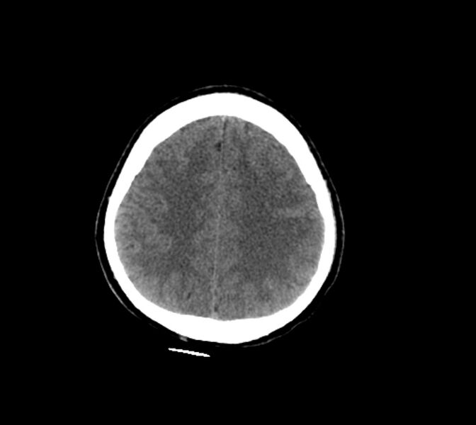 File:Cerebral fat embolism (Radiopaedia 37510-39362 Axial non-contrast 25).jpg