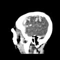 Cerebral hemorrhagic contusions (Radiopaedia 23145-23188 C 37).jpg