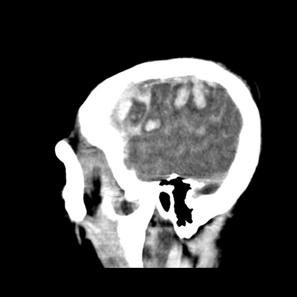 File:Cerebral hemorrhagic contusions (Radiopaedia 23145-23188 C 37).jpg