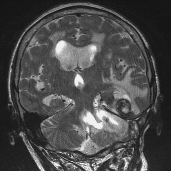 File:Cerebral radiation necrosis (Radiopaedia 7248-8188 Coronal T2 1).jpg