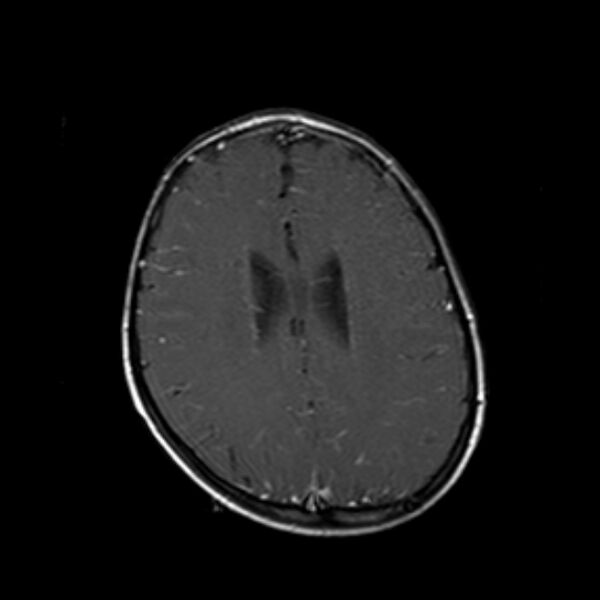 File:Cerebral tuberculoma (Radiopaedia 41152-43932 Axial T1 C+ 15).jpg