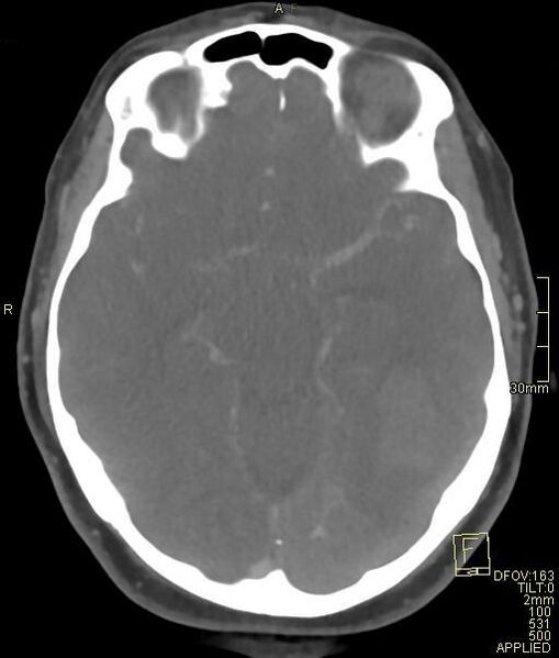 File:Cerebral venous sinus thrombosis (Radiopaedia 91329-108965 Axial venogram 35).jpg