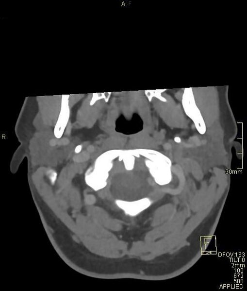 File:Cerebral venous sinus thrombosis (Radiopaedia 91329-108965 Axial venogram 7).jpg