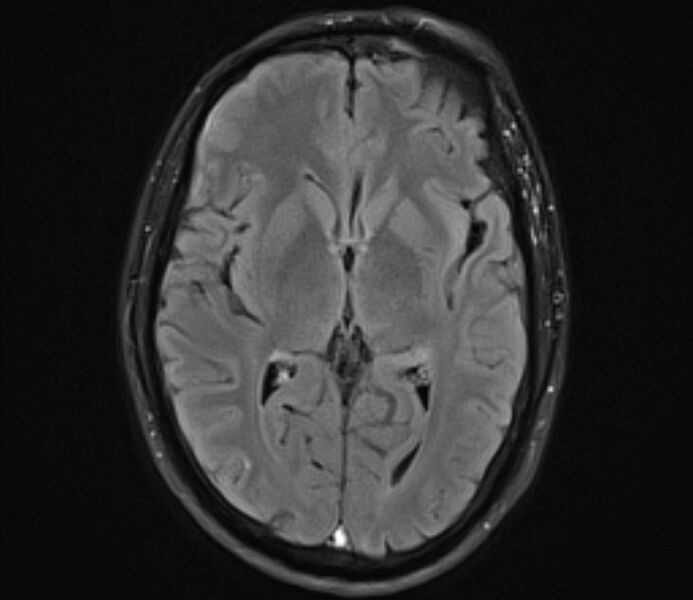 File:Cerebral venous thrombosis (Radiopaedia 71207-81504 Axial FLAIR 14).jpg