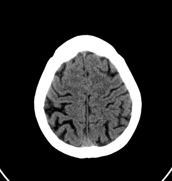 File:Cerebral venous thrombosis - CT only (Radiopaedia 41031-43778 Axial non-contrast 11).jpg