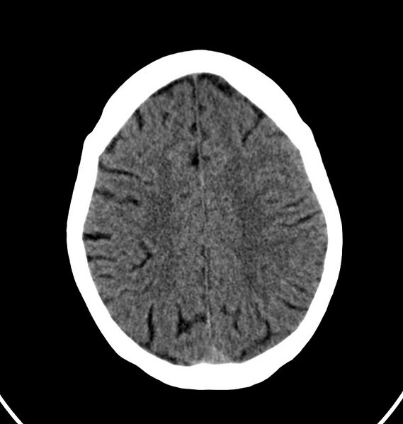 File:Cerebral venous thrombosis - CT only (Radiopaedia 41031-43778 Axial non-contrast 21).jpg