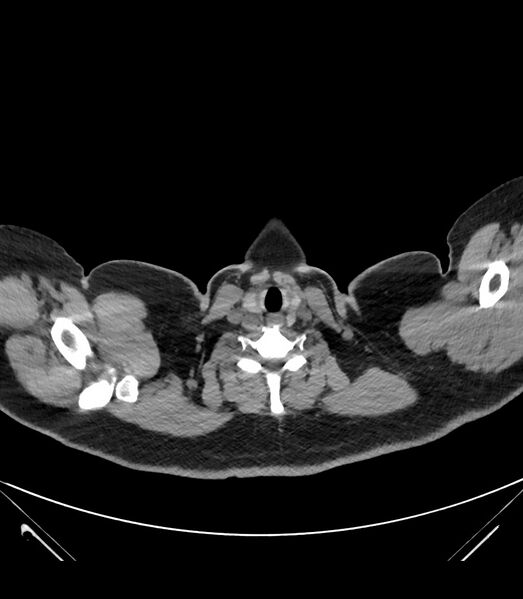 File:Cervical aortic arch with coarctation and aneurysms (Radiopaedia 44035-47552 Axial non-contrast 3).jpg