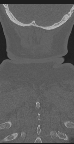 File:Cervical canal stenosis due to ossification of the posterior longitudinal ligament (Radiopaedia 47260-51823 Coronal bone window 67).png