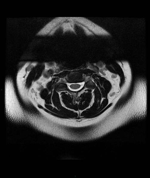 File:Cervical disc prolapse (Radiopaedia 80258-93598 Axial T2 9).jpg