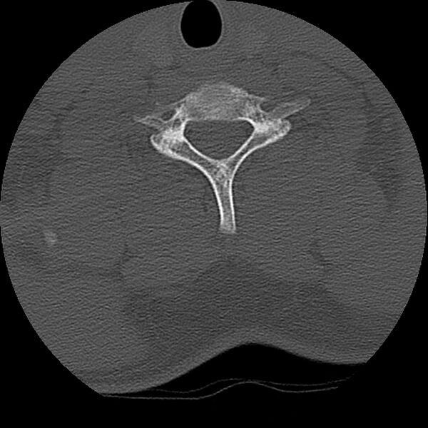 File:Cervical flexion teardrop fracture with cord hemorrhage (Radiopaedia 32497-33454 Axial bone window 66).jpg