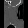 Cervical flexion teardrop fracture with cord hemorrhage (Radiopaedia 32497-33454 Sagittal bone window 2).jpg