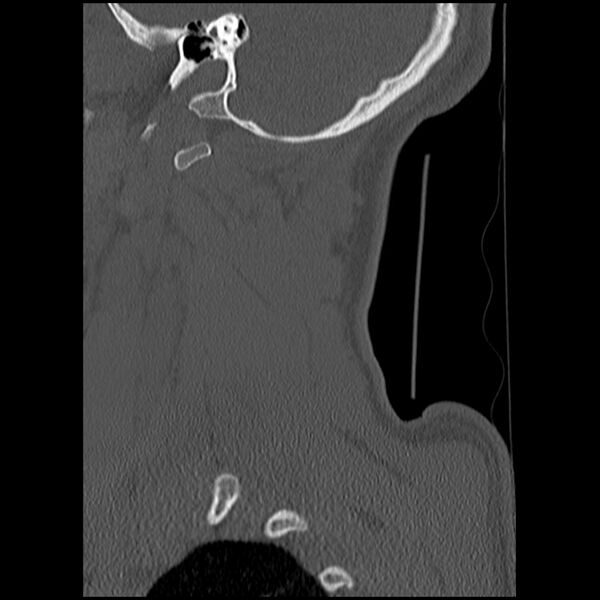 File:Cervical flexion teardrop fracture with cord hemorrhage (Radiopaedia 32497-33454 Sagittal bone window 2).jpg