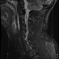 Cervical flexion teardrop fracture with cord hemorrhage (Radiopaedia 32497-33455 Sagittal STIR 13).jpg