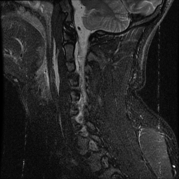 File:Cervical flexion teardrop fracture with cord hemorrhage (Radiopaedia 32497-33455 Sagittal STIR 13).jpg