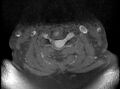 Cervical schwannoma (Radiopaedia 72399-82934 Axial T1 C+ fat sat 10).jpg