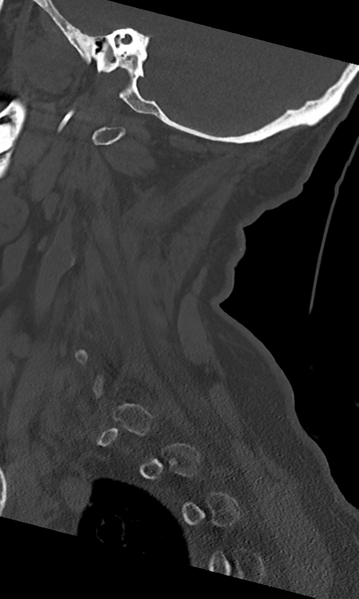 File:Cervical spine fracture - chalk stick (Radiopaedia 39116-41323 Sagittal bone window 15).png