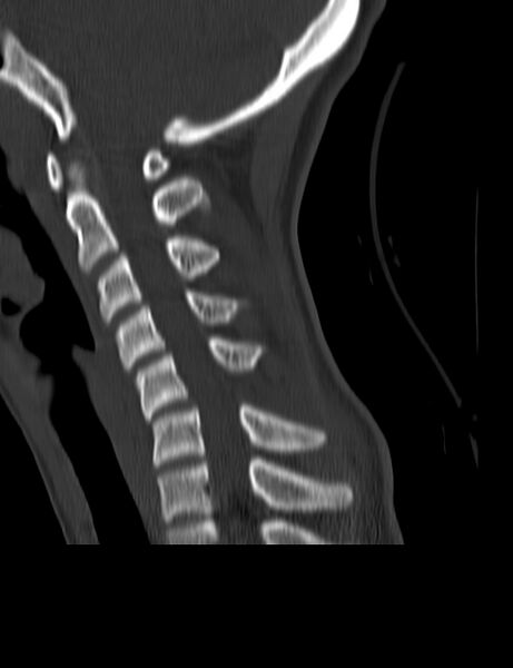 File:Cervical spine posterior ligamentous complex rupture (Radiopaedia 63486-72101 Sagittal bone window 11).jpg