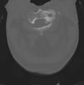 Cervical spondylolysis (Radiopaedia 49616-54811 Axial bone window 16).png