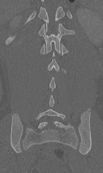 File:Chance fracture (Radiopaedia 40360-42912 Coronal bone window 51).png