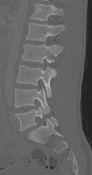 File:Chance fracture (Radiopaedia 40360-42912 Sagittal bone window 41).png