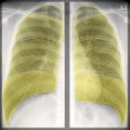 Chest x-ray - breathing (Radiopaedia 32556-33507 C 1).jpg