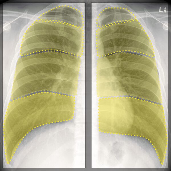 File:Chest x-ray - breathing (Radiopaedia 32556-33507 C 1).jpg