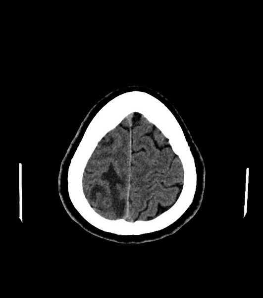 File:Cholangiocarcinoma with cerebral metastases (Radiopaedia 83519-98628 Axial non-contrast 56).jpg