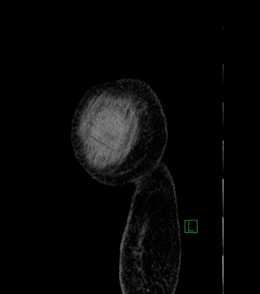 File:Cholangiocarcinoma with cerebral metastases (Radiopaedia 83519-98629 F 5).jpg
