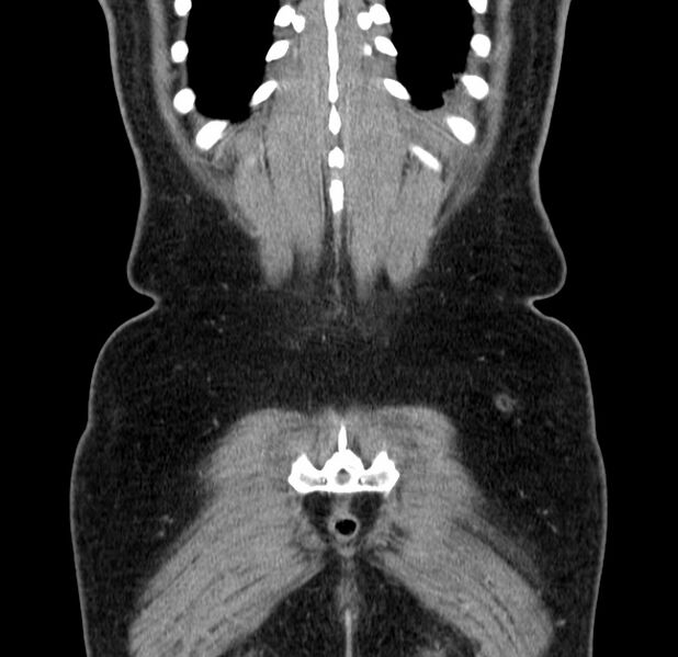 File:Choledocholithiasis on CT and MRI (Radiopaedia 24825-25087 C 49).jpg