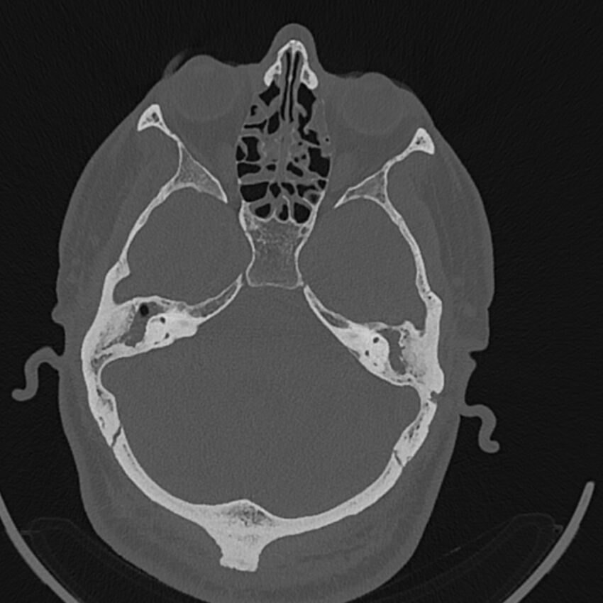 Cholesteatoma (Radiopaedia 68176-77673 Axial bone window 54).jpg