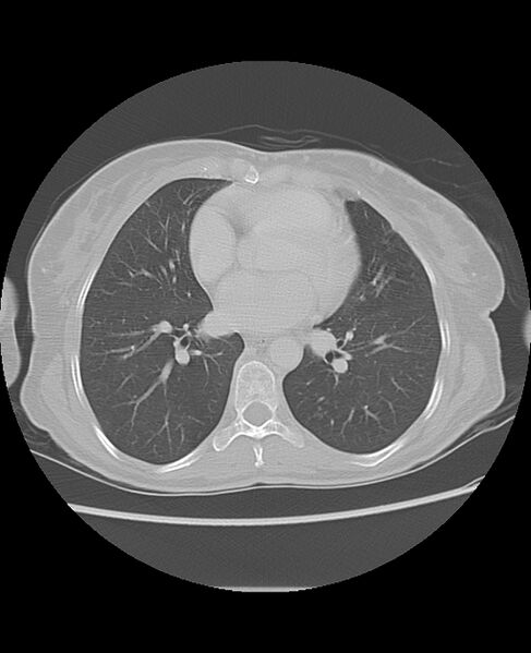 File:Chondrosarcoma (Radiopaedia 79427-92532 Axial lung window 33).jpg