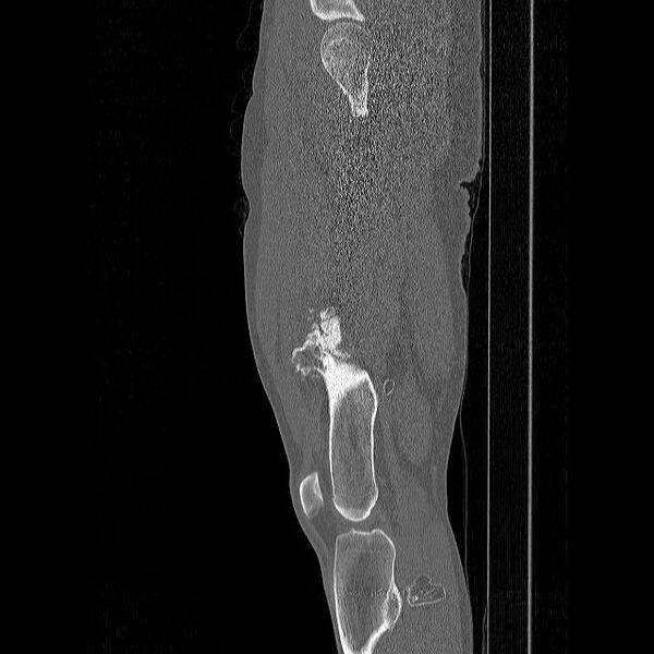 File:Chondrosarcoma arising from exostosis (Radiopaedia 59996-67507 Sagittal bone window 7).jpg
