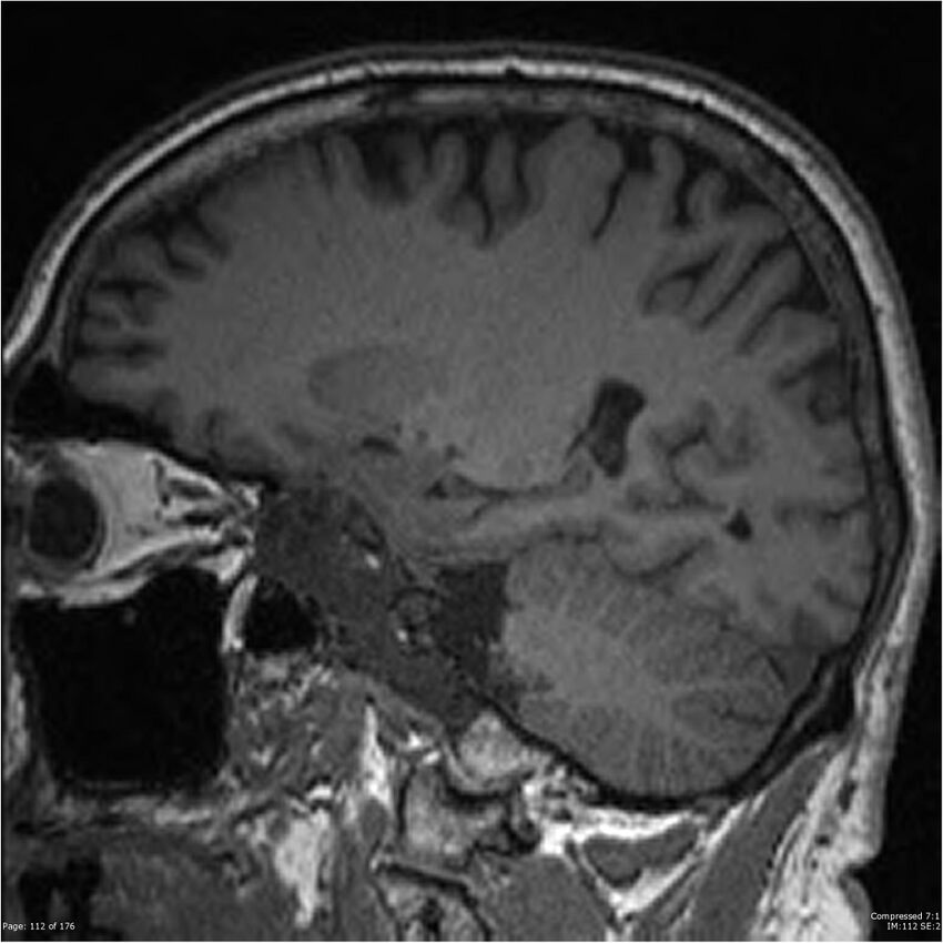 Chondrosarcoma of skull base- grade II (Radiopaedia 40948-43654 Sagittal T1 35).jpg