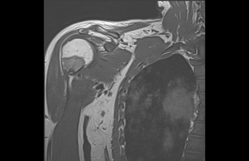 File:Choriocarcinoma in the shoulder (Radiopaedia 28603-28861 Coronal T1 3).jpg