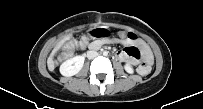 File:Choriocarcinoma liver metastases (Radiopaedia 74768-85766 A 114).jpg