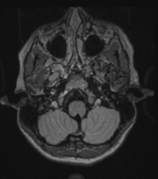 File:Choroid plexus carcinoma (Radiopaedia 91013-108553 Axial FLAIR C+ 84).jpg