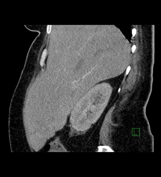 File:Chromophobe renal cell carcinoma (Radiopaedia 84239-99519 D 89).jpg