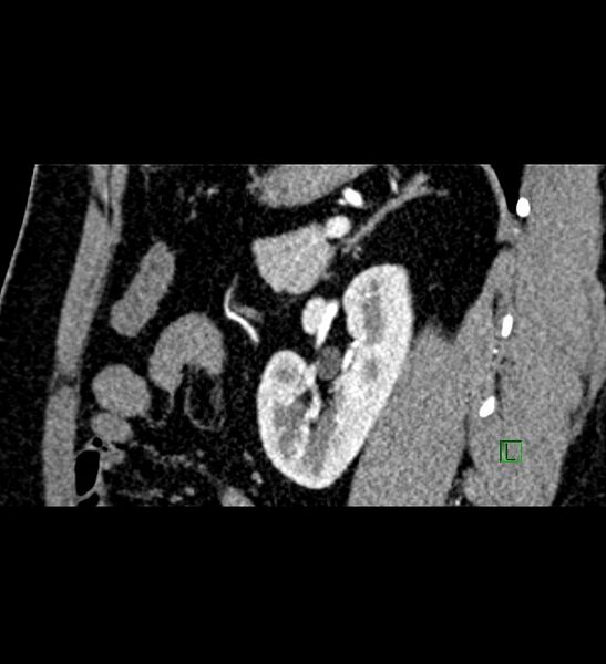 File:Chromophobe renal cell carcinoma (Radiopaedia 84286-99573 F 54).jpg