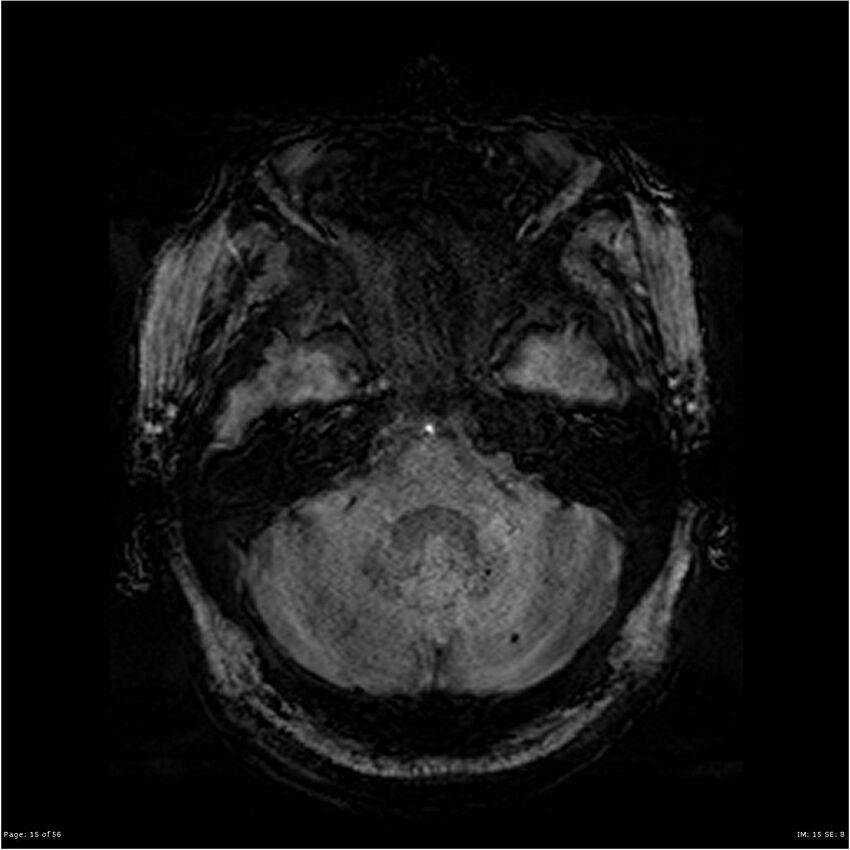 Chronic hypertensive encephalopathy (Radiopaedia 25764-25918 Axial SWI 18).jpg