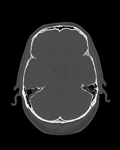 File:Chronic maxillary sinusitis caused by a foreign body (Radiopaedia 58521-65676 Axial bone window 291).jpg