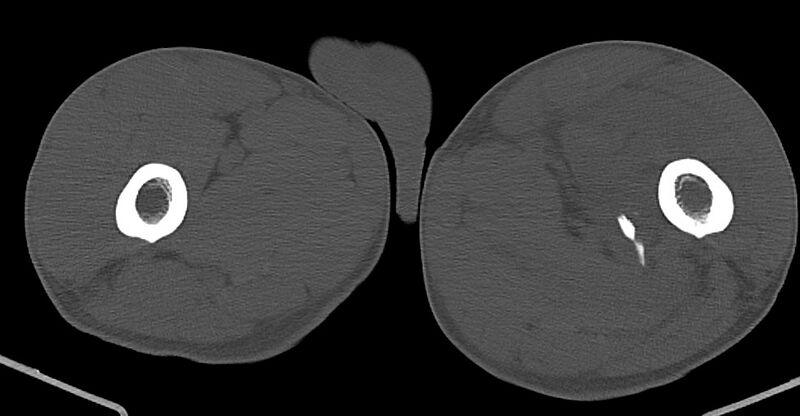 File:Chronic osteomyelitis (with sequestrum) (Radiopaedia 74813-85822 Axial non-contrast 73).jpg