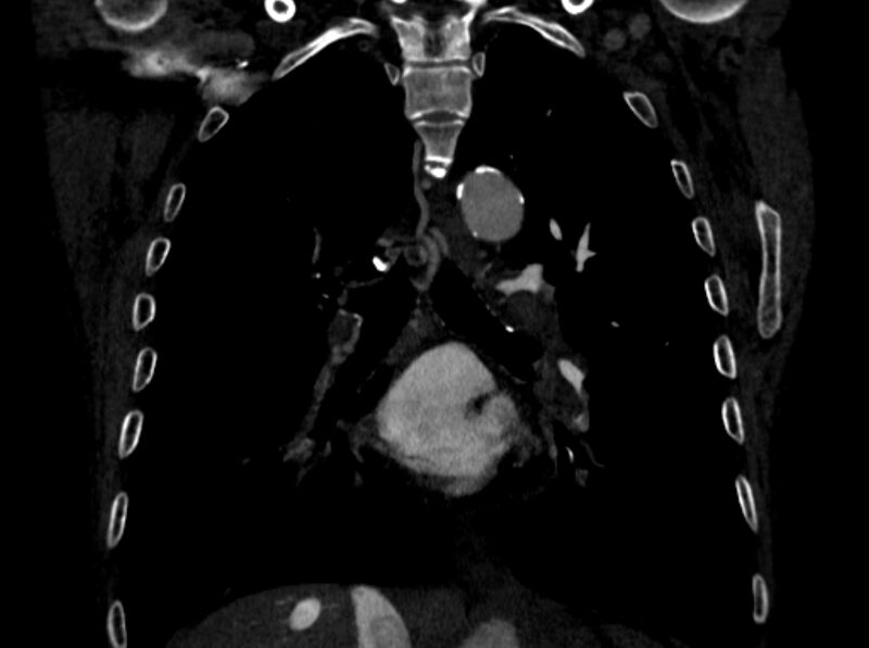 File:Chronic pulmonary embolism (Radiopaedia 91241-108843 A 64).jpg