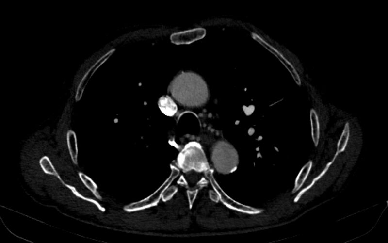 File:Chronic pulmonary embolism (Radiopaedia 91241-108843 B 65).jpg