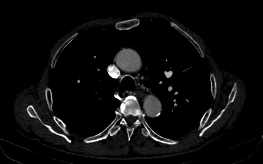 Chronic pulmonary embolism (Radiopaedia 91241-108843 B 65).jpg