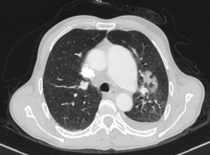 Chronic pulmonary embolism with bubbly consolidation (Radiopaedia 91248-108850 Axial lung window 56).jpg