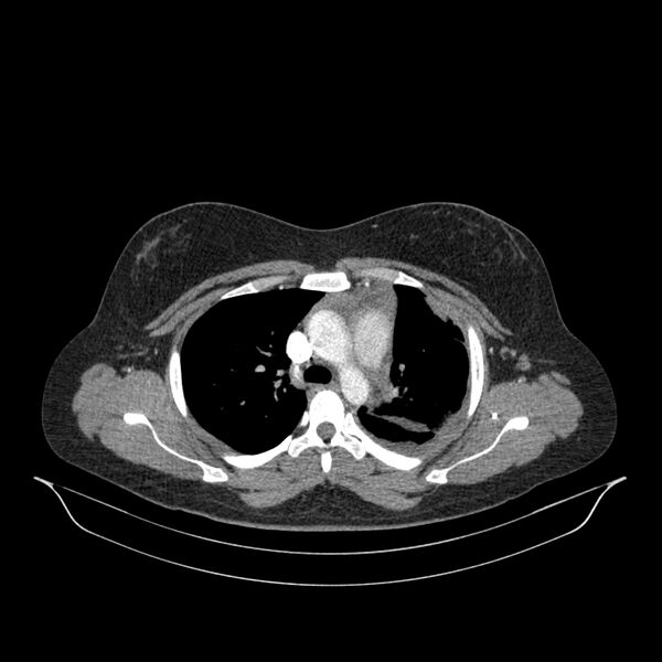 File:Chronic thromboembolic pulmonary hypertension (CTEPH) (Radiopaedia 74597-85532 Axial C+ CTPA 110).jpg