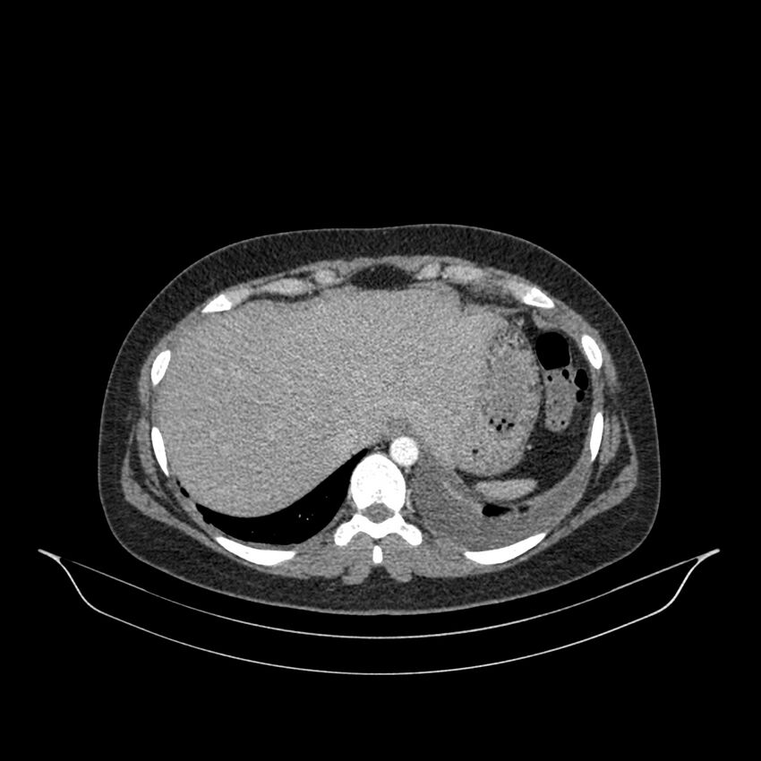 Chronic thromboembolic pulmonary hypertension (CTEPH) (Radiopaedia 74597-85532 Axial C+ CTPA 26).jpg