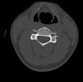Clay-shoveler fracture (Radiopaedia 22568-22590 Axial bone window 34).jpg