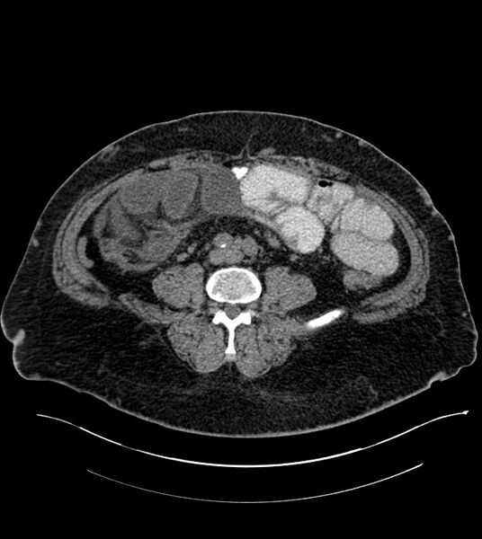 File:Closed-loop small bowel obstruction-internal hernia (Radiopaedia 78439-91096 Axial non-contrast 98).jpg