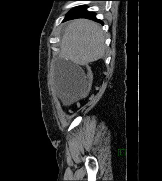 File:Closed-loop small bowel obstruction-internal hernia (Radiopaedia 78439-91096 C 123).jpg